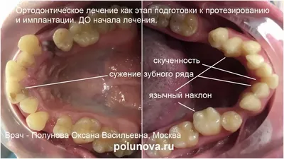 Что делать в случаях, когда суженная челюсть. Как исправлять прикус? |  Клиника Ортодонтика, Москва