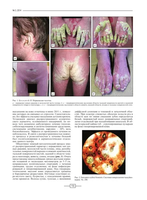 Добрый Доктор - Чесотка заболевание, вызываемое клещом (Sarcoptes scabiei),  способным паразитировать в коже человека. Чесоточный клещ распространен  повсеместно, и в мире ежегодно регистрируется не менее 300 млн. больных.  Заражение детей происходит от