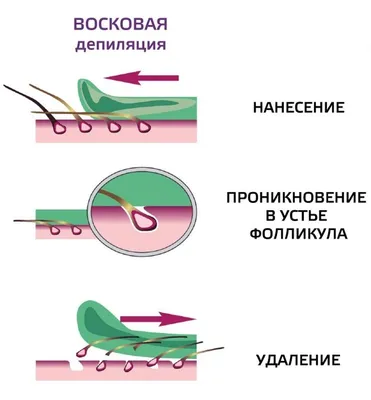 Что лучше: депиляция воском или шугаринг? | gladkO