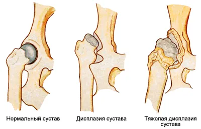 Врач рассказывает о дисплазии тазобедренных и локтевых суставов