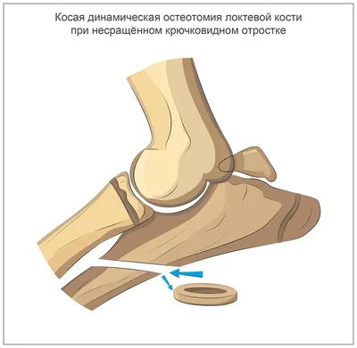 Дисплазия плечевого сустава у корги