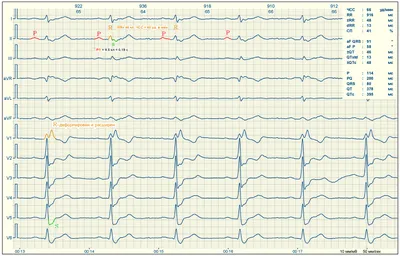 Расшифровка ЭКГ для чайников с примерами - E-Cardio