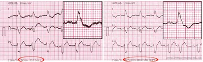 Фильтры записи ЭКГ