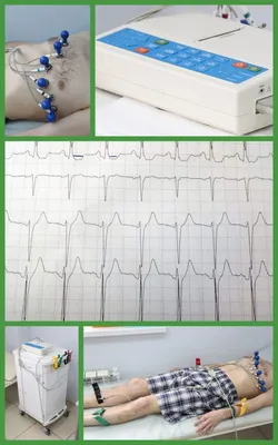 Контурный анализ ЭКГ: анализ сердечного ритма - Аппаратно-программные  комплексы БИОРС