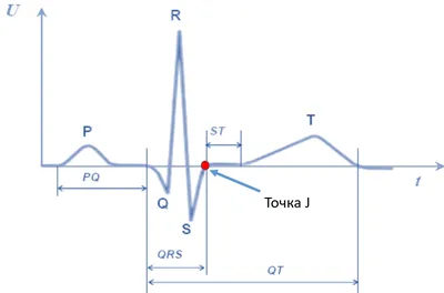 Ребята,помогите! Нужна расшифровка ЭКГ по фото | Пикабу