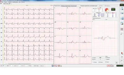 Снятие и расшифровка ЭКГ детям в Ростове к.м.н. в МЦ Гераци