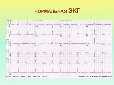 ЭКГ - что можно узнать о состоянии организма? | Здоровое тело | Дзен