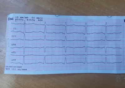 Электрокардиограмма (ЭКГ)
