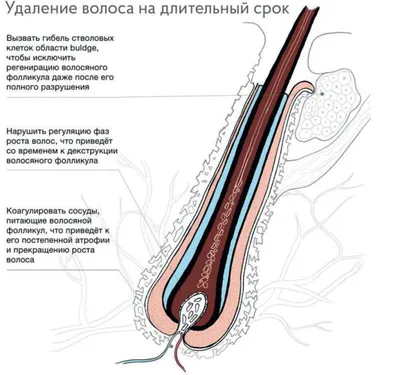 Электроэпиляция в центре медицинской косметологии Вега