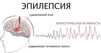 Всё о эпилепсии | Научно-практический центр детской психоневрологии