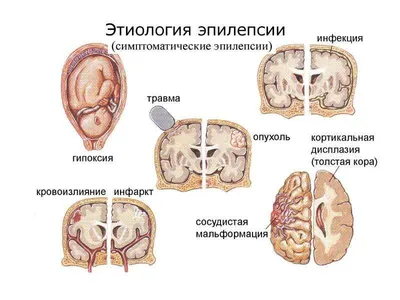 ЭЭГ. Эпилепсия | Электроэнцефалография | Дзен