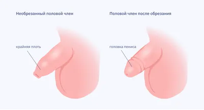 Фимоз (лечение фимоза): симптомы, диагностика и лечение в клинике Universum  Clinic