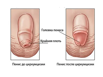 Ох уж этот фимоз | Медицинский центр Дуэт Клиник.