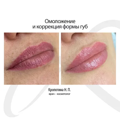 Увеличение губ гиалуроновой кислотой — Damas Medical Center