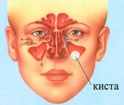 Киста гайморовой пазухи - признаки, причины, симптомы, лечение и  профилактика - iDoctor.kz