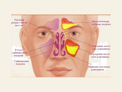 Лечение синусита в Николаеве: лечение воспаление слизистой