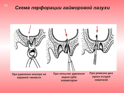 Рентгенография придаточных пазух носа