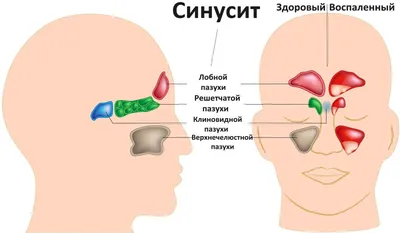 Голова болит, нос не дышит и температура: что такое гайморит и чем он  опасен? | О здоровье: с медицинского на русский | Дзен