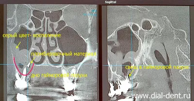 Перфорация гайморовой пазухи при удалении зуба
