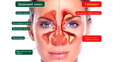 Гайморит | Клиника Добрый Доктор г. Красноярск