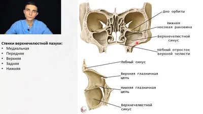 Имплантация зубов при наличии свища в гайморовой пазухе