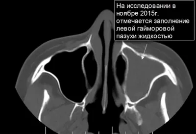 Острый гнойный гайморит - лечение взрослых в клинике врача ЛОРа Дмитрия  Субботы с отзывами пациентов в Москве