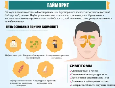 Гайморит: причины, симптомы и лечение в статье ЛОРа Зайцев В. М.