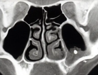 Исследование пазух носа | Портал радиологов