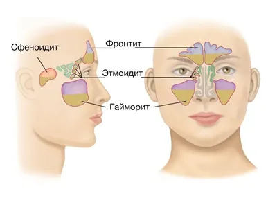 Что такое гайморит? Причины появления, симптомы и лечение