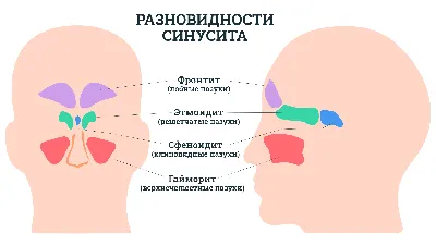 Одонтогенный гайморит (одонтогенный верхнечелюстной синусит) | НоваДент