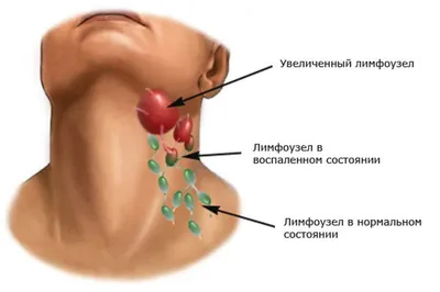 Лимфатические узлы - количество, строение, увеличение лимфоузлов  (лимфоаденопатия)