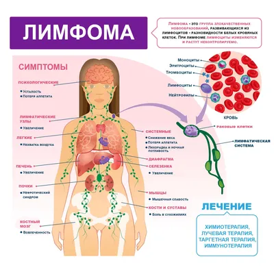 Симптомы и признаки неходжкинской лимфомы - Городская больница № 4