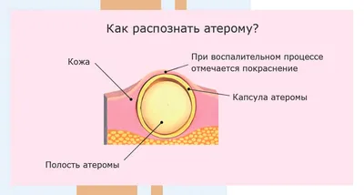 Воспаление лимфоузлов под мышкой - причины, симптомы и методы лечения