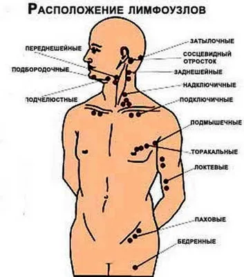 Лимфаденопатия — Википедия