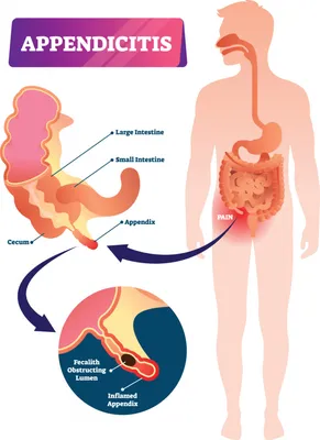 Где находится аппендикс, зачем он нужен и как распознать аппендицит