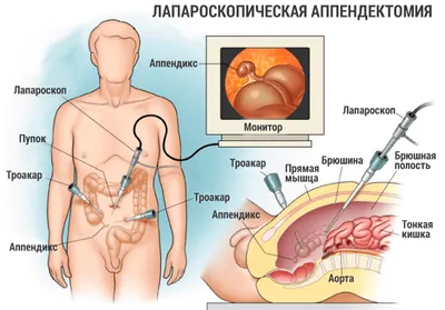 Аппендицит: симптомы у взрослых и детей | Диагностика и лечение аппендицита  в АО «Медицина»