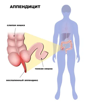 Аппендэктомия