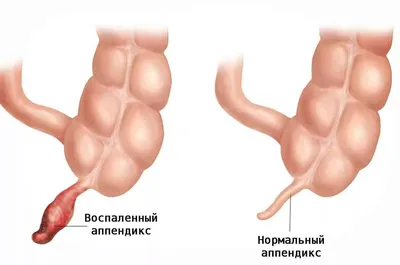 Первые симптомы аппендицита | ПРАВДИВАЯ ОНКОЛОГИЯ | Дзен