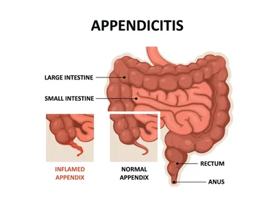 Первые симптомы аппендицита: ранние признаки опасного заболевания - 4 июня  2023 - ФОНТАНКА.ру
