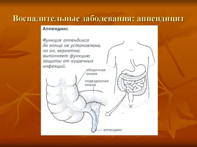 Аппендицит — Википедия