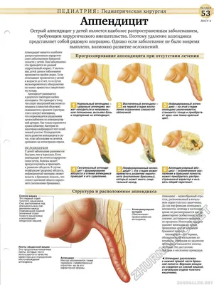 Аппендицит — Википедия