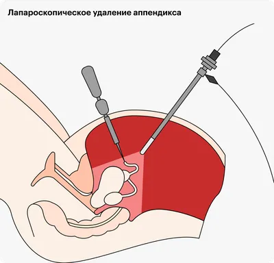 Аппендицит Острый Желудок Находится На Теле Женщины Серый Фон Анатомия  Концепции — стоковые фотографии и другие картинки Антисанитарный - iStock