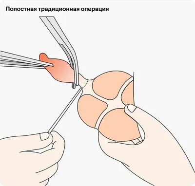 Аппендицит: с какой стороны находится, симптомы, признаки, диагностика и  лечение