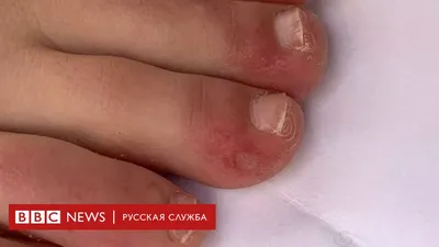 Откуда берётся сыпь на теле и что с этим делать - Лайфхакер