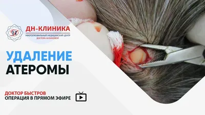 Шишка На Губе Небе Во Рту 9 Фото Опухоль ЛюмиДент