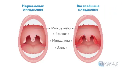 Ангина: гнойная, фолликулярная, фото, симптомы, лечение