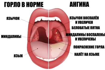 Герпесная ангина у ребенка 3 года чем лечить