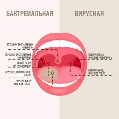 Герпетический стоматит - причины, симптомы, признаки, диагностика, лечение,  профилактика, рекомендации