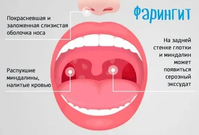 Вирус коксаки, герпесная ангина — 24 ответов | форум Babyblog