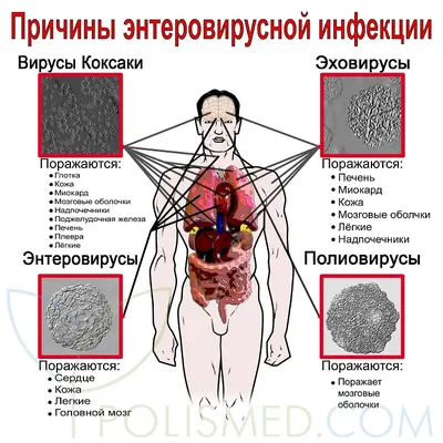 Лор | Махачкала on Instagram: \"Герпетическая ангина – острое инфекционное  заболевание, которое вызывают энтеровирусы. Герпангина не имеет отношения к  вирусу герпеса. ⠀ Название связано с тем, что высыпания в горле при болезни